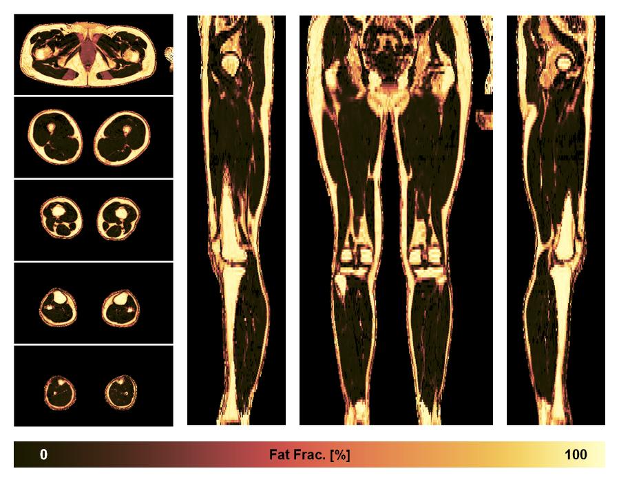 The fat fraction of the lower extremity obtained from the dixon reconstruction for muscle water fat quantification.